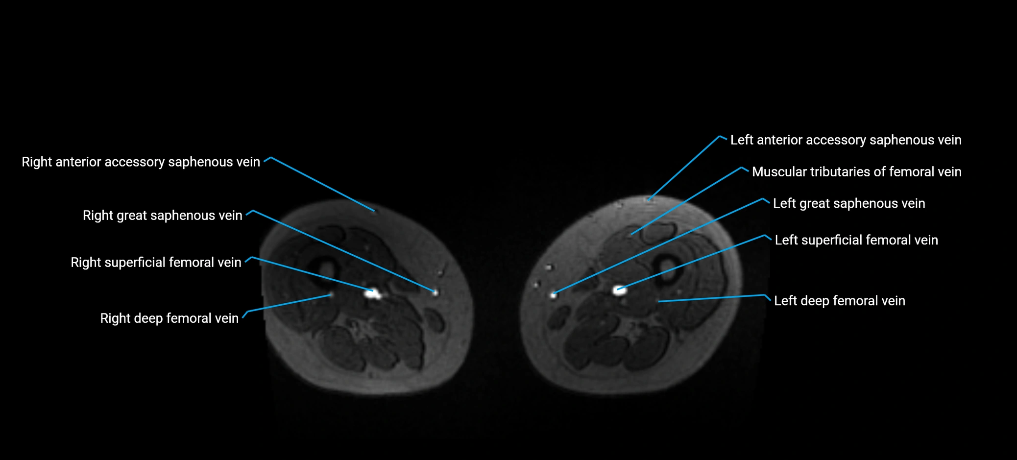 MRV abdomen pelvis & lower limb axial cross sectional anatomy labelled MRI image 293 (1).webp